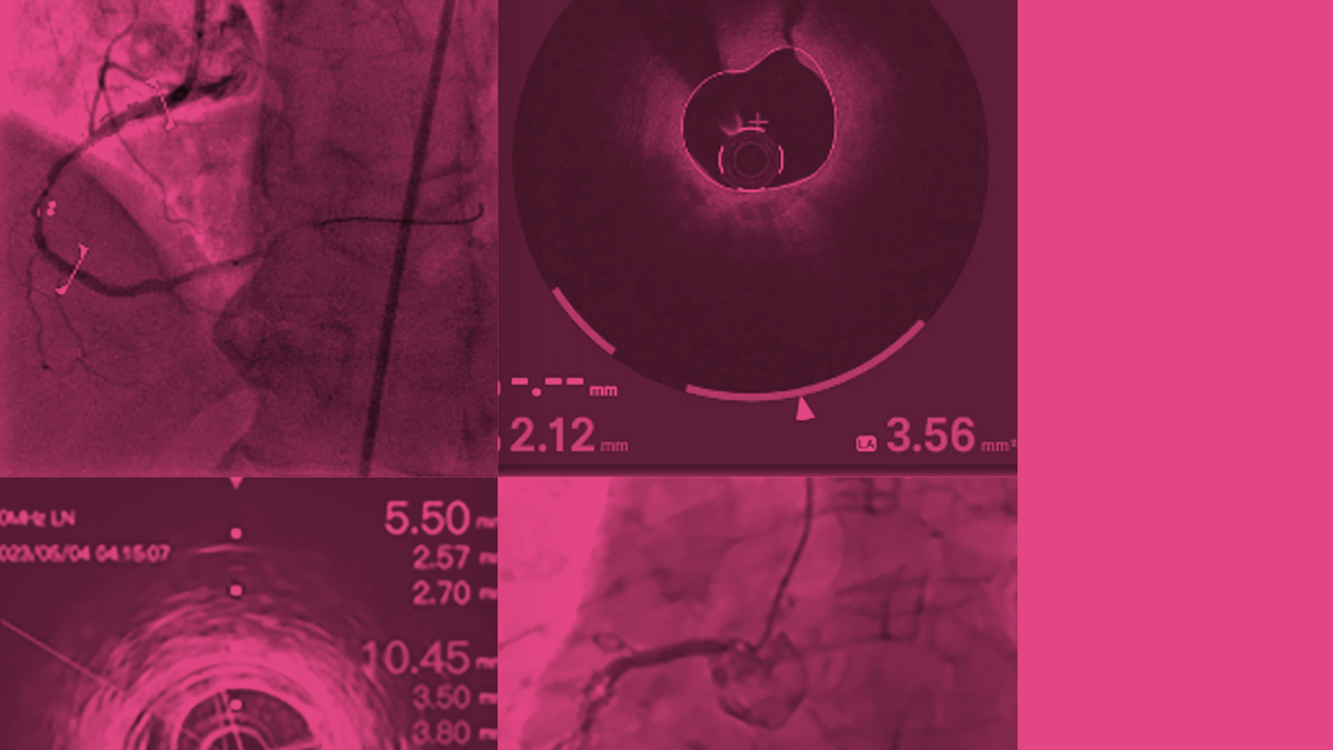 Bildgebung Thema IVUS-OCT