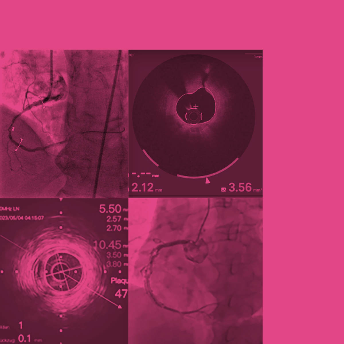 Bildgebung Thema IVUS-OCT