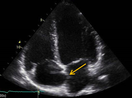 Synkopen Abbildung 1
