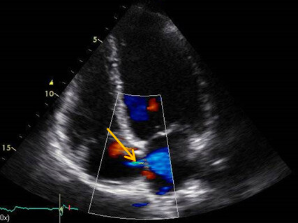 Synkopen Abbildung 2