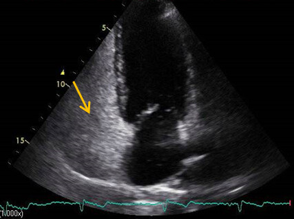 Synkopen Abbildung 3