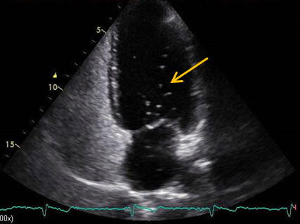 Synkopen Abbildung 4
