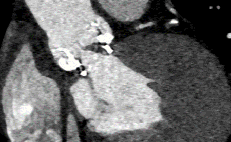 kardiale-bildgebung-klappenthrombose