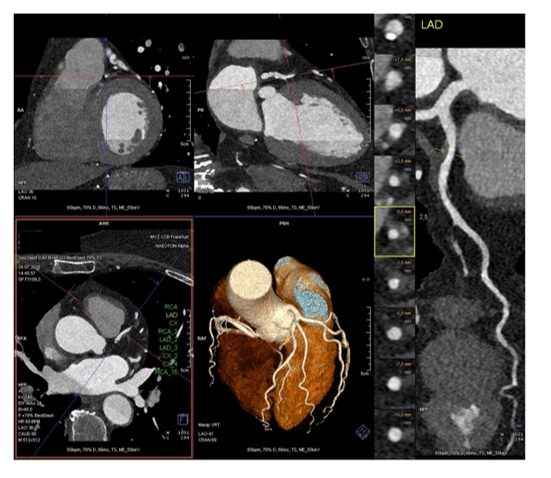 kardiale-ct-multiplanare-rekonstruktion