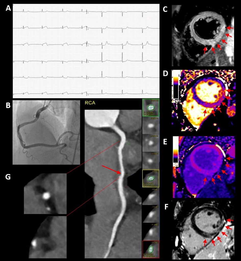 Myokardinfarkt-multimodale-Bildgebung