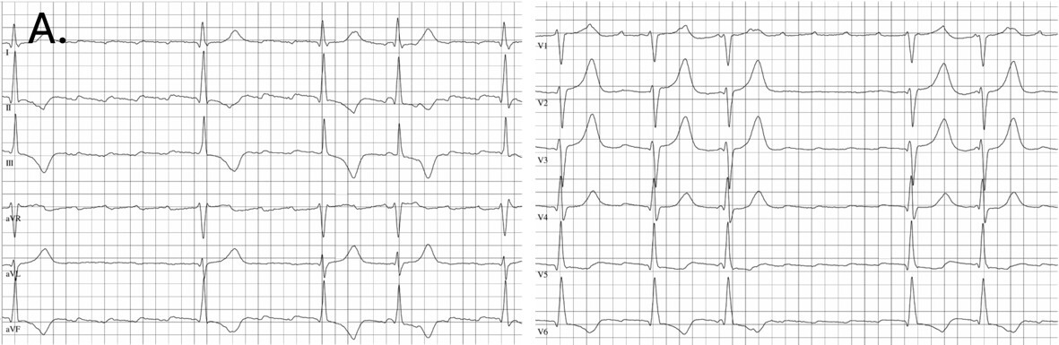12-Kanal-EKG mit typischem Vorhofflattern
