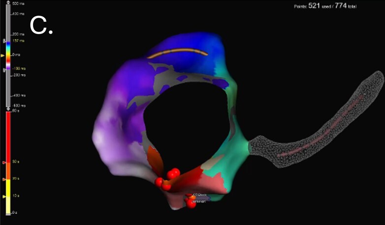Fokussiertes 3D-Mapping des rechten Vorhofs mit Darstellung des Reentry-Kreislaufs bei typischem Vorhofflattern. Der CS ist grau gepunktet dargestellt. Die roten Punkte sind die Ablationspunkte am CTI.