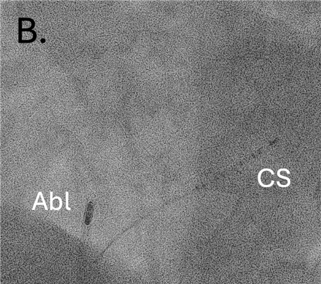 Fluoroskopisches Bild (LAO 45°) einer typischen Lage intrakardialer Katheter für eine Ablation des cavotrikuspidalen Isthmus (CTI). Ein 10-poliger Katheter liegt im Koronarsinus (CS). Der Ablationskatheter (Abl.) liegt am CTI.