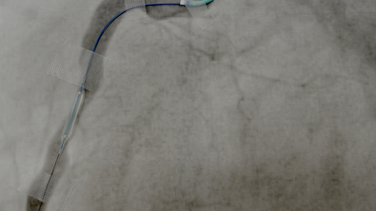Ballondilatation