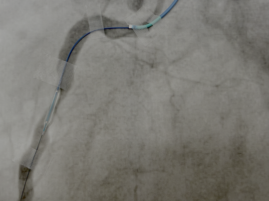 Ballondilatation