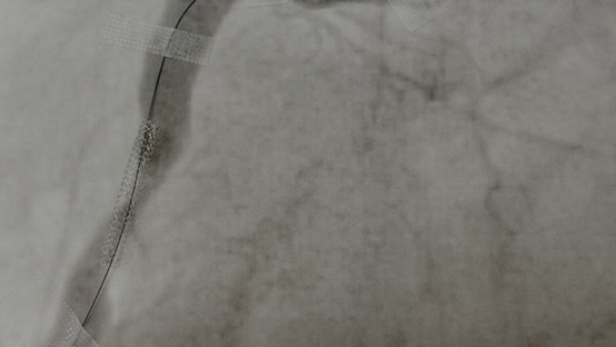Implantierter Stent
