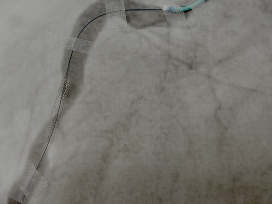 Implantierter Stent