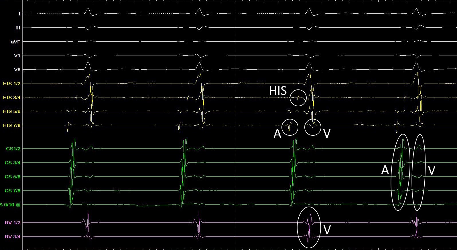Intrakardiale Signale der Katheter während eines unauffälligen Sinusrhythmus. 