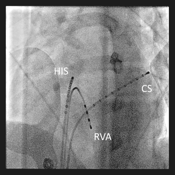 Fluoroskopisches Bild einer typischen Lage intrakardialer Katheter für eine diagnostische EPU.