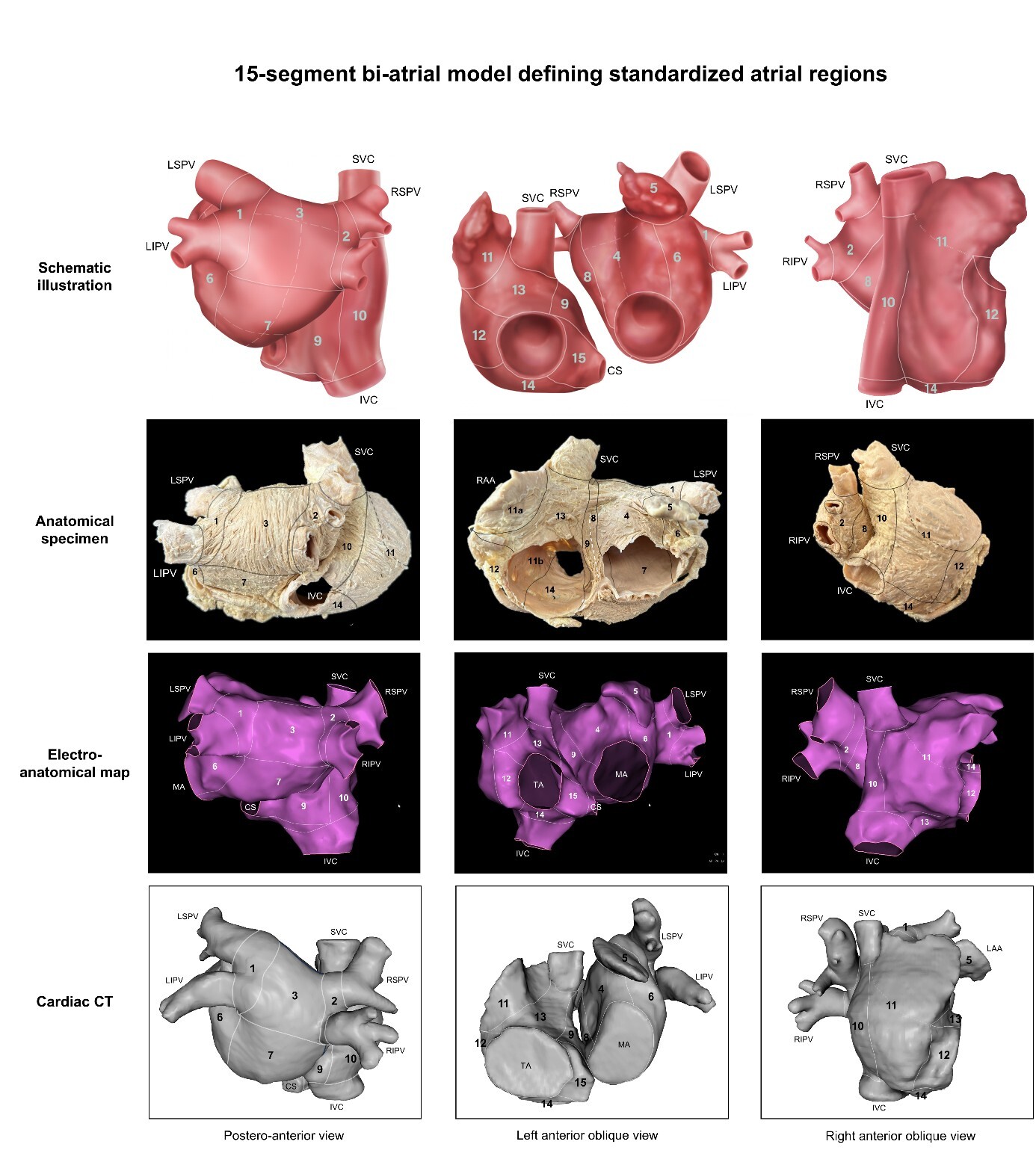 15-segment bi-atrial model