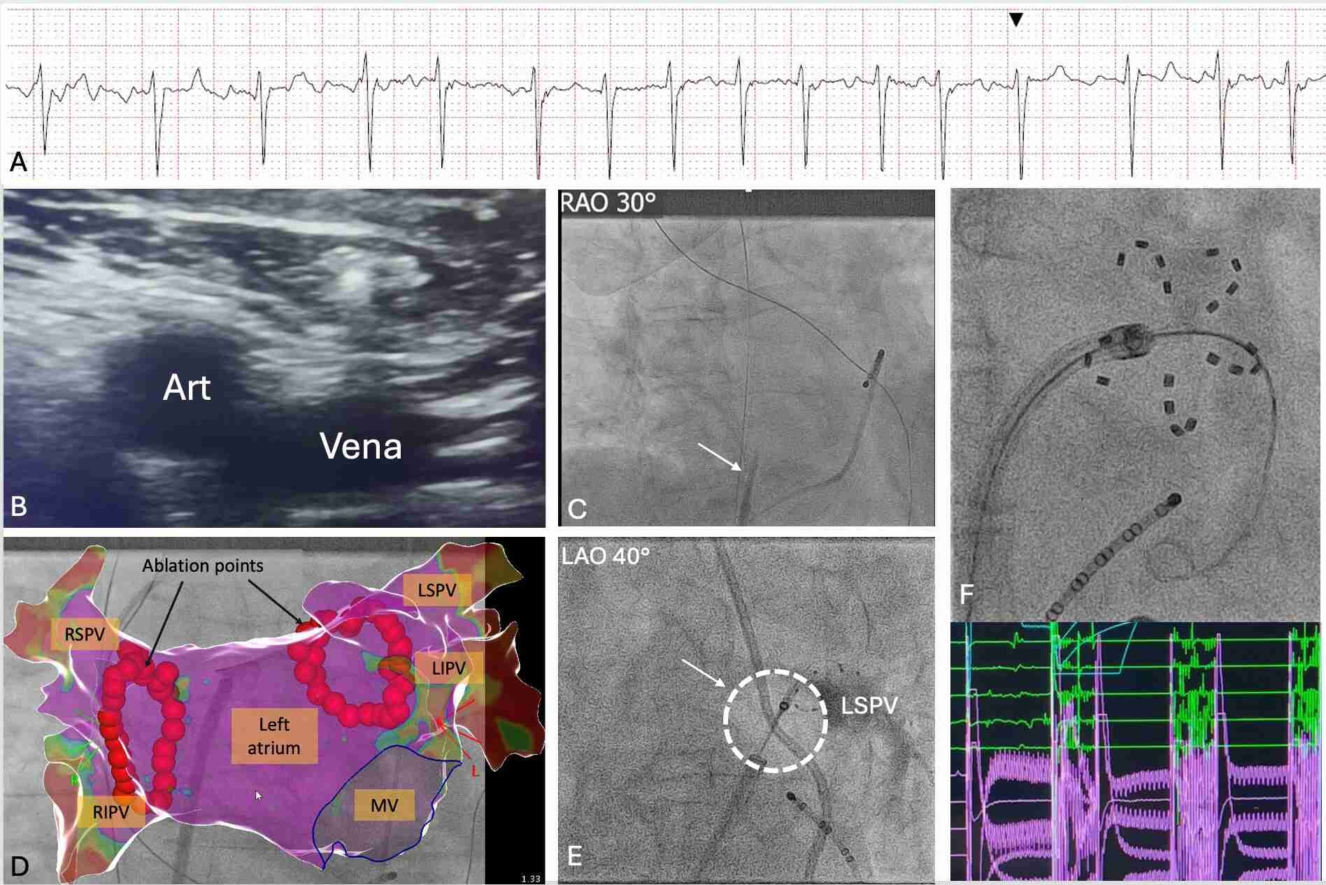 pulmonalvenenisolation-komp