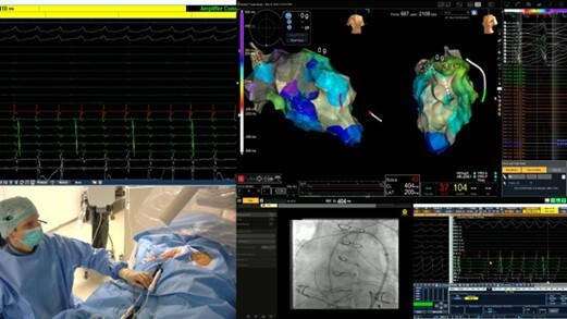 remote-support-ablation-1
