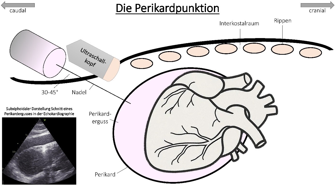 darstellung-perikardpunktion