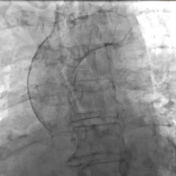 kardiale-bildgebung-aorta-1zu1-576x576