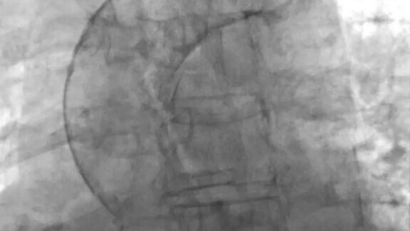 kardiale-bildgebung-aorta-1zu1-576x576