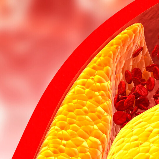 cholesterin-plaque-aterie-shutterstock-1496594564-32x9-1920x540px