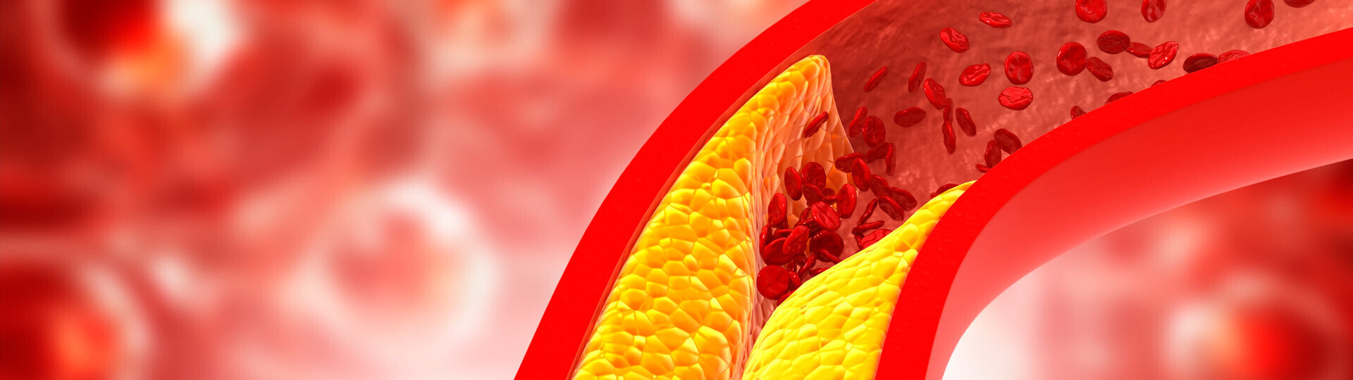 cholesterin-plaque-aterie-shutterstock-1496594564-32x9-1920x540px