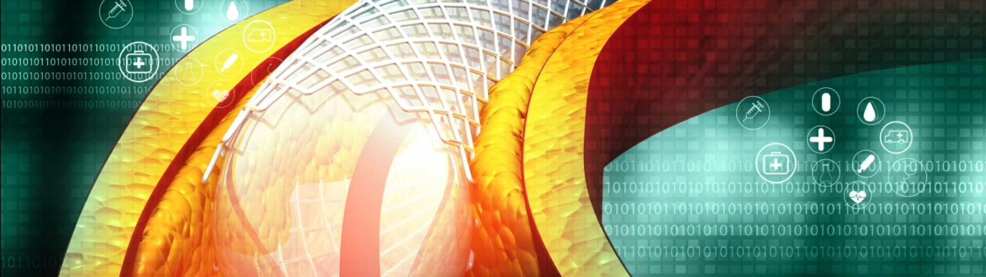 balloon-stent-shutterstock-1486417064-32zu9-1920x540