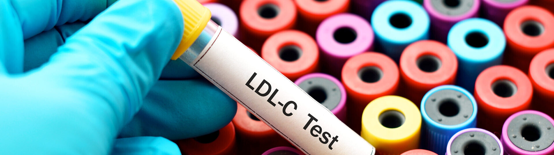 blutprobe-ldl-c-shutterstock-505935169-32zu9-1920x540px