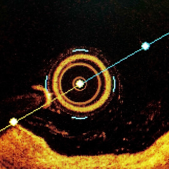 oct-intravaskulaere-bildgebung-shutterstock-2186368653-32zu9-1920x540