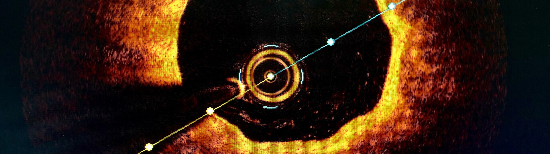 oct-intravaskulaere-bildgebung-shutterstock-2186368653-32zu9-1920x540