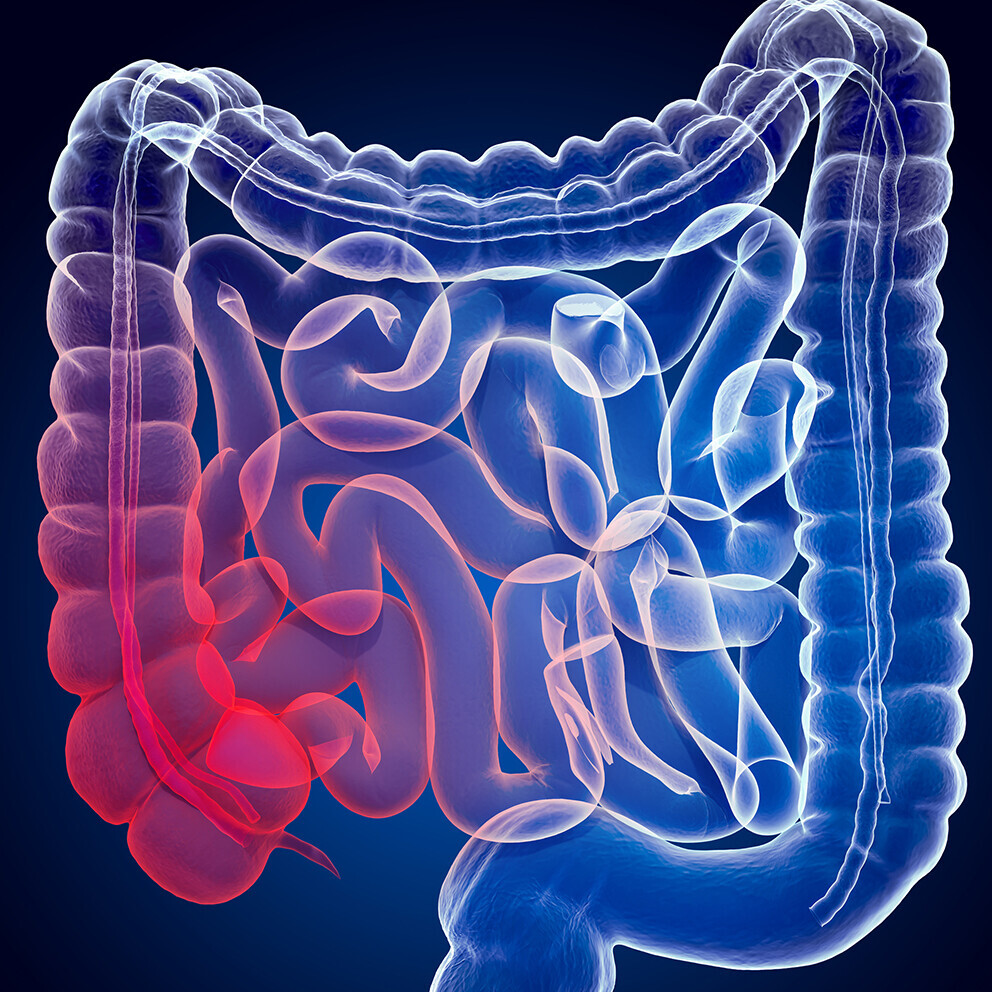 colitis-ulcerosa-herzerkrankung-1204703706_H