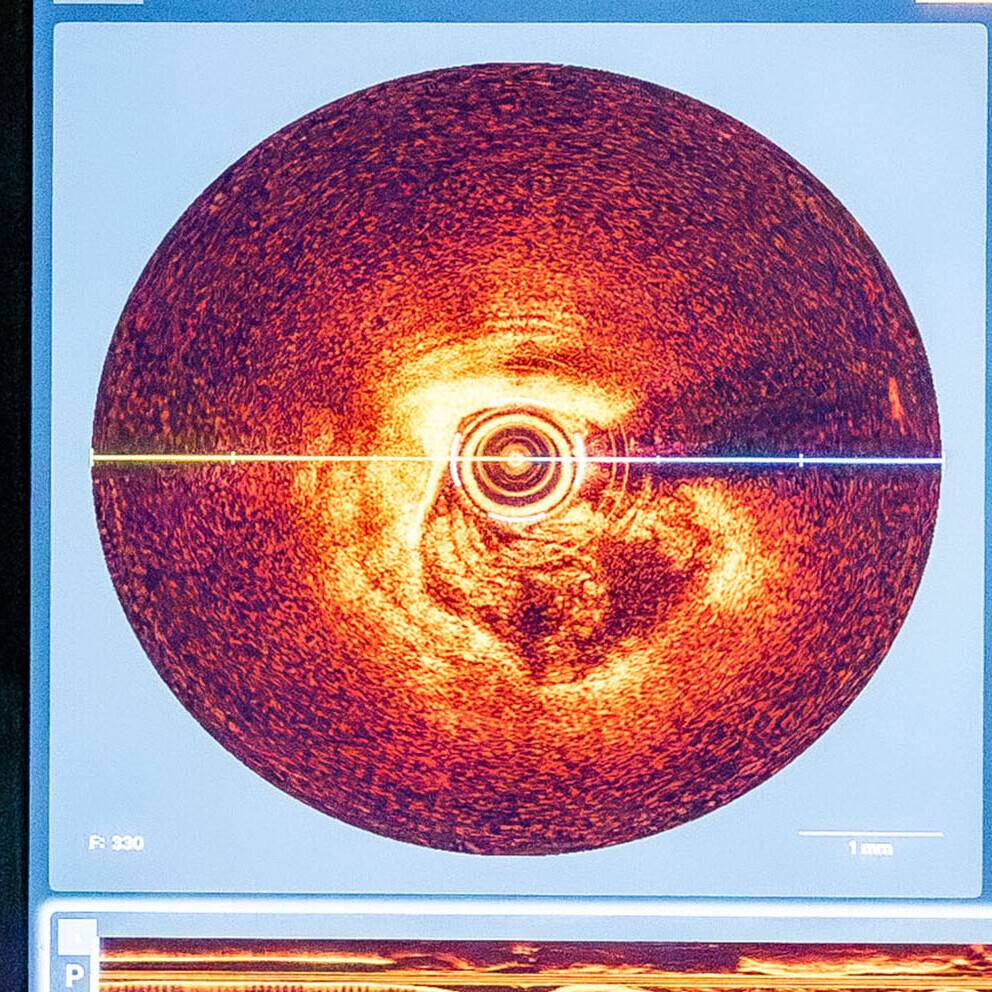 optische-kohaerenztomographie_H