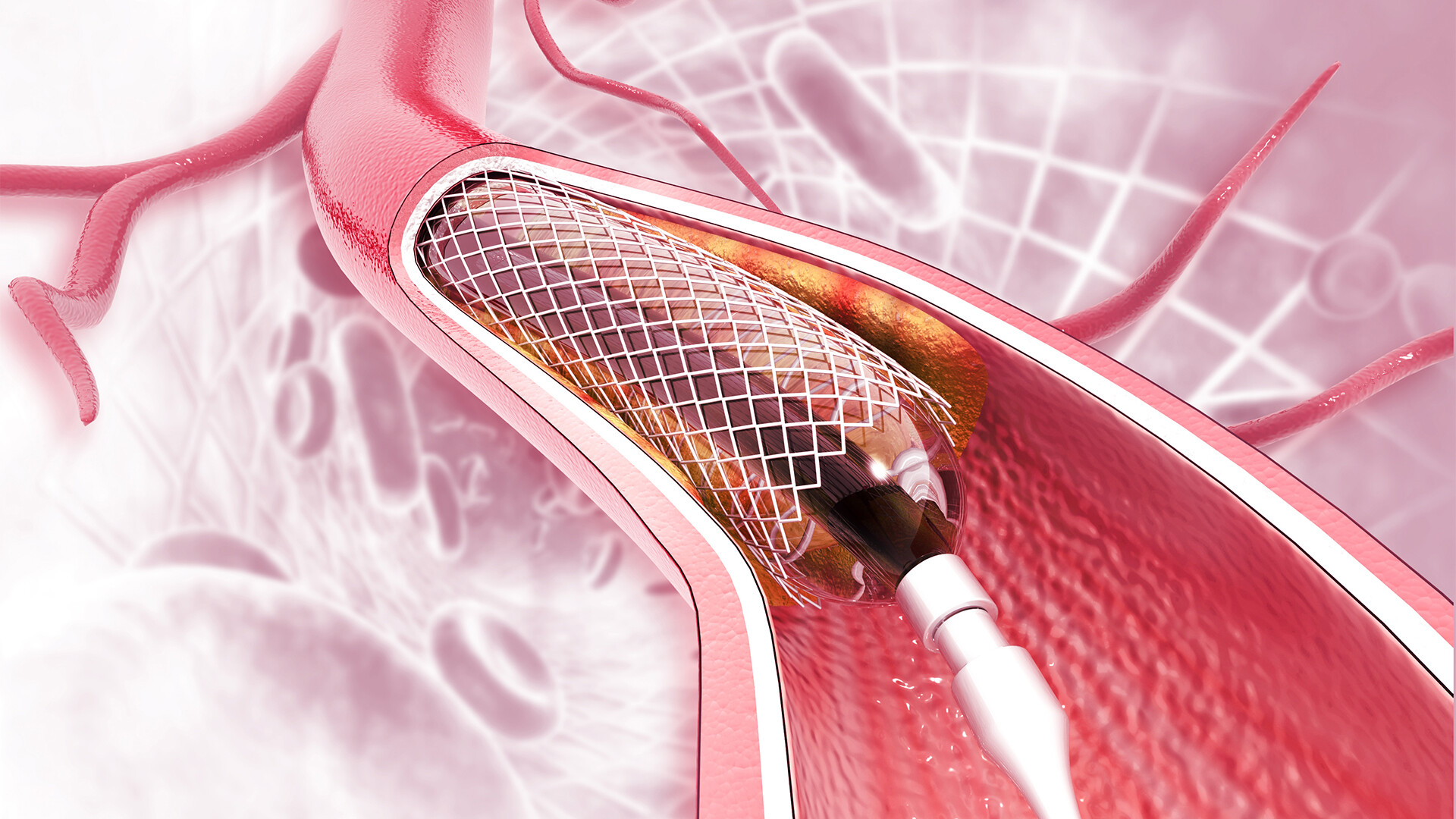 stent-implantation-iStock-1183309129-it