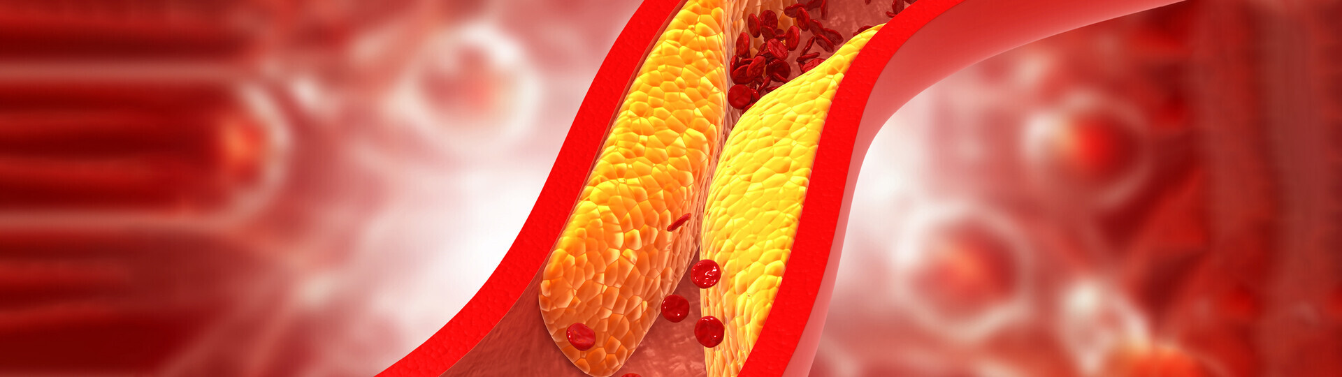 koronare-herzkrankheit-ursachen--1255871988_H