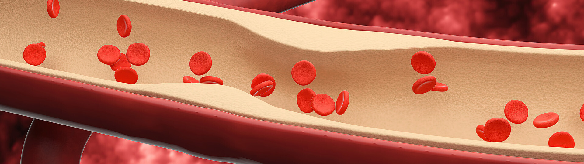herzinfarkt-ursachen-1317911590-h