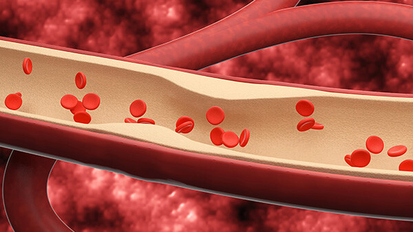 herzinfarkt-ursachen-1317911590-t