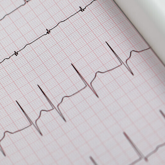 vorhofflimmern-diagnose-537596177-h