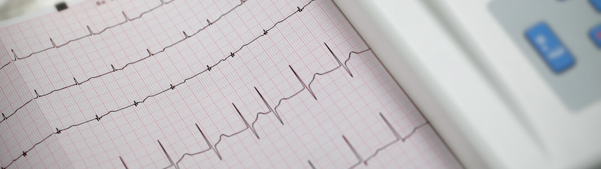 vorhofflimmern-diagnose-537596177-h
