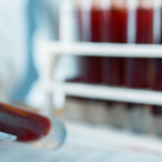 familiaere-hypercholesterinaemie-iStock-1174677845-h