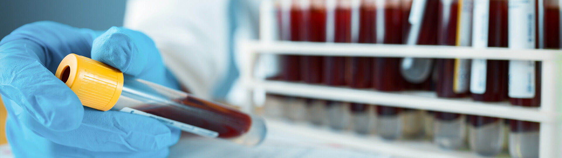 familiaere-hypercholesterinaemie-iStock-1174677845-h