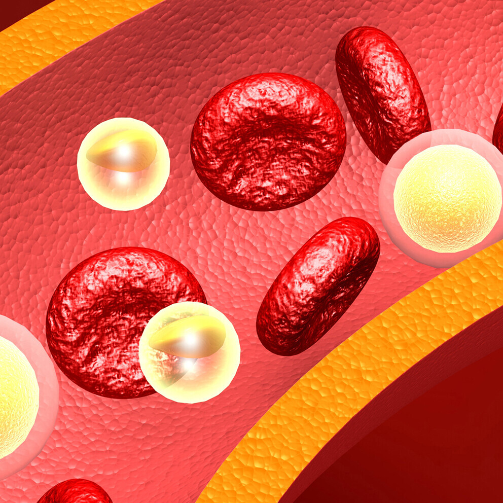 familiaere-hypercholesterinaemie-ursache-symptome-1295764369_Header