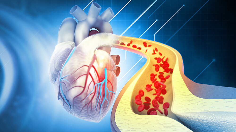 verkalkung-blutgefaesse-1457623083_Teaser