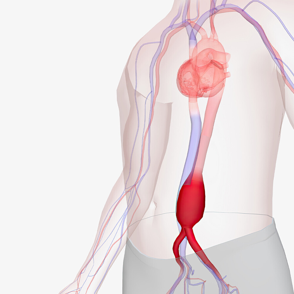 aortenaneurysma-1720439376_H