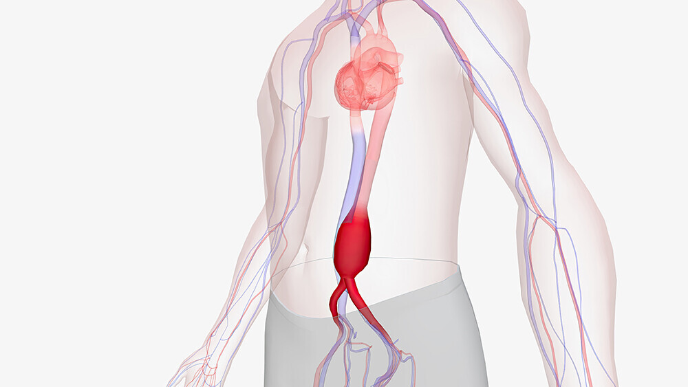 aortenaneurysma-1720439376_T