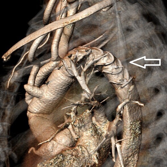 3D-CT-Angiografie der Patientin nach Operation; Pfeil zeigt die Hybridprothese