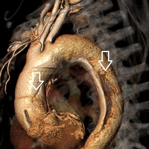 CT-Angiographie Prä-OP
