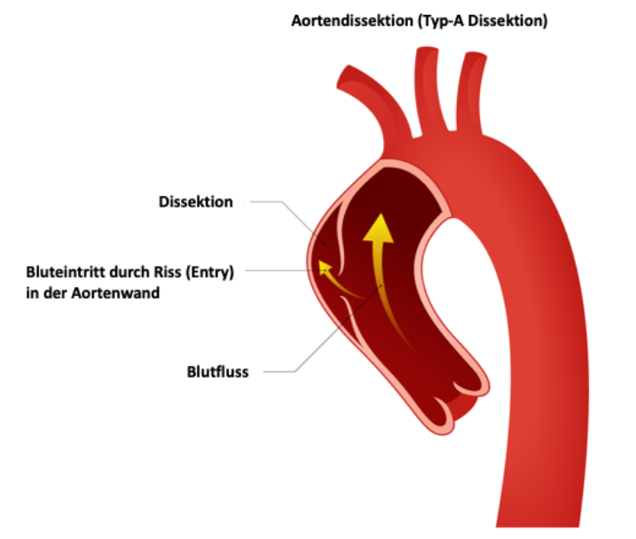 Schema Aortendissektion