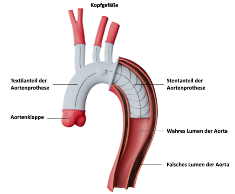 Aortenersatz mittels Hybridprothese (Thoraflex™ Hybrid Plexus)