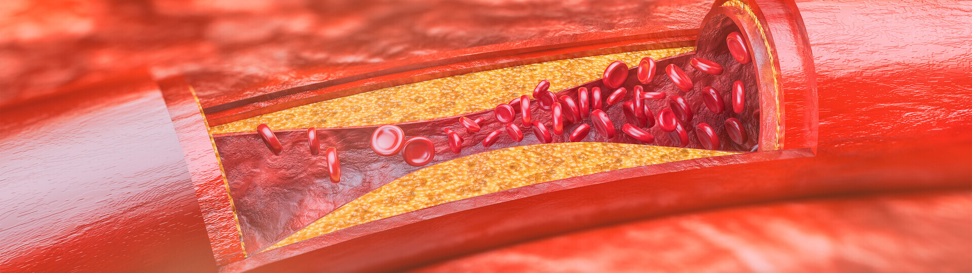 atherosklerose-958536398_H