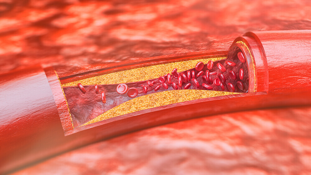 atherosklerose-958536398_T